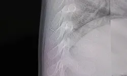 Bebeğin sırtından tel parçası çıktı