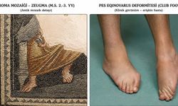 1800 yıllık Zeugma mozaiğinde tıbbi iz