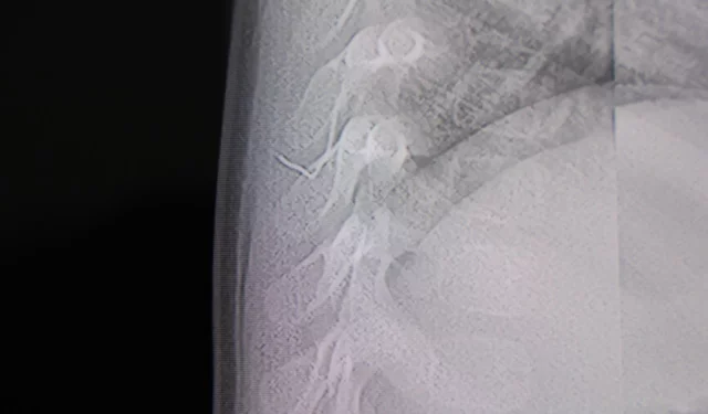 Bebeğin sırtından tel parçası çıktı