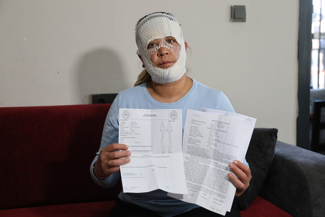 Güzelleşmek uğruna gittiği merkezde yüzü yandı